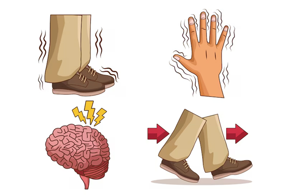Parkinson and Movement Disorders