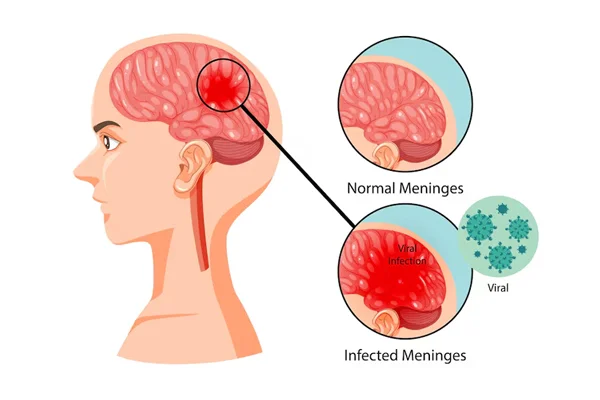 Meningitis Encephalitis and Infections